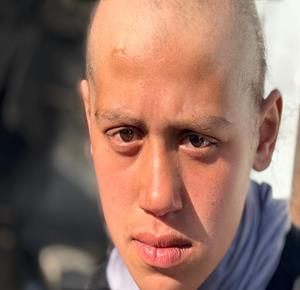 الطفلة لما أبو مطيير  (15 عاما)، تعاني من تساقط كامل للشعر بسبب داء الثعلبة الذي اصابها نتيجة الظروف الإنسانية الصعبة ونقص الرعاية الصحية المتوفرة في مخيم الشاطئ للاجئين غرب مدينة غزة