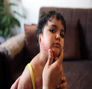 الطفلة مسك من غزة تعاني آثار الحروق التي أصيبت بها جراء العدوان الإسرائيلي، وتنتظر السفر لتلقي العلاج في الخارج