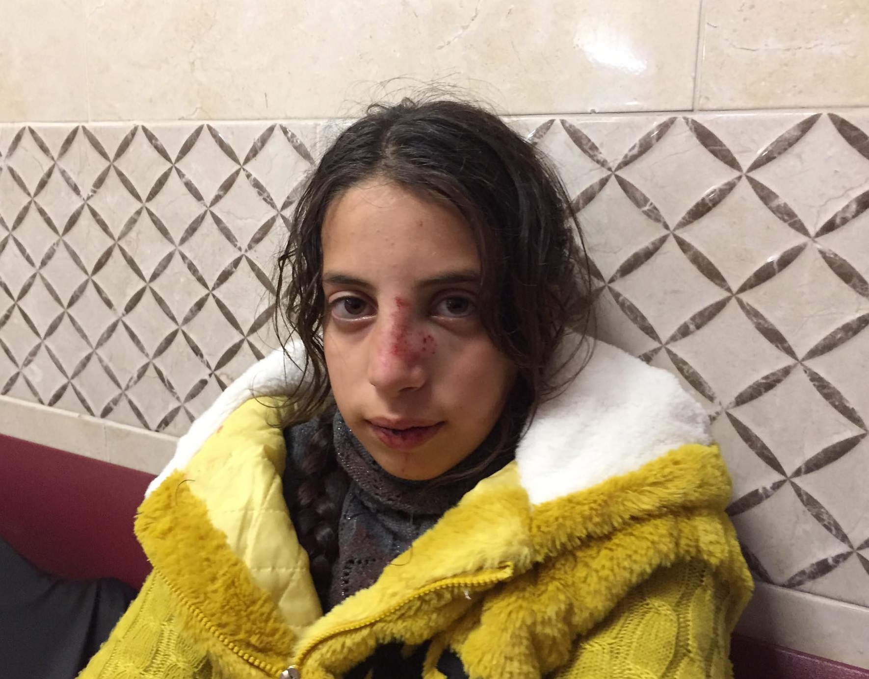 الطفلة حلا القط تتلقى العلاج في المستشفى بعد إصابتها بجروح إثر اعتداء للمستوطنين على منزل عائلتها بقرية مادما (وفا)
