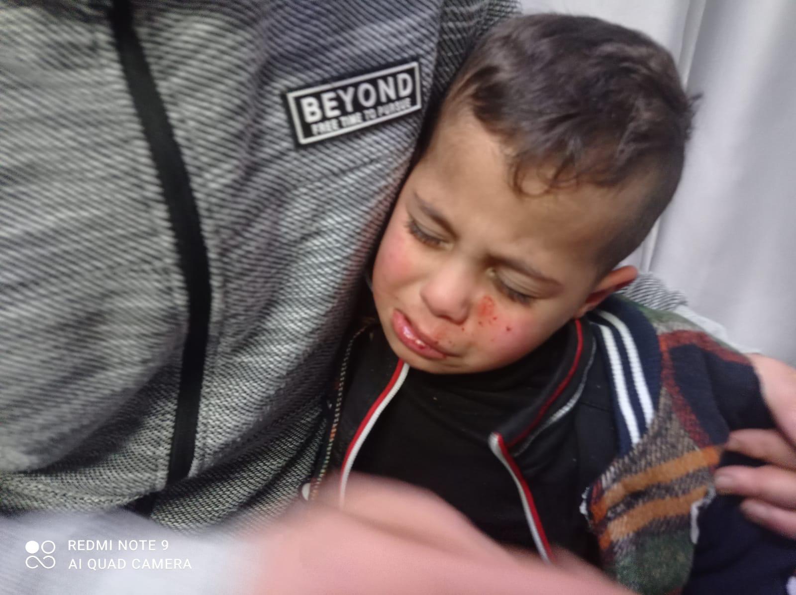 l’enfant Jad Alaa Sawafta (3 ans) a été blessé au visage suite à une attaque des colons contre le véhicule de son père