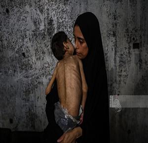 5 وفيات من بينها 3 أطفال نتيجة المجاعة وسوء التغذية خلال الـ24 ساعة الماضية