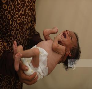 وفاة 5 مواطنين بينهم طفلان خلال الـ24 ساعة الماضية بسبب سوء التغذية والمجاعة