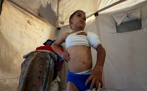 طفل من غزة مصاب بحروق ويحتاج لعمليات جراحية 