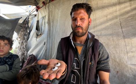 العدوان على غزة يورّث لؤي إعاقات دائمة 