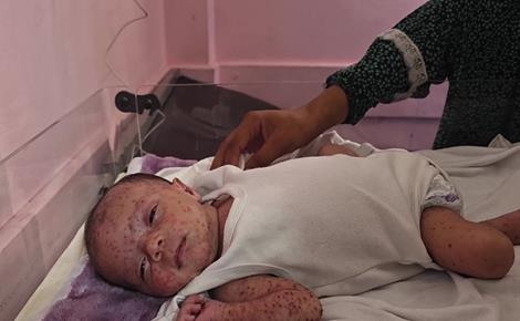 انتشار جدري الماء بين النازحين في غزة