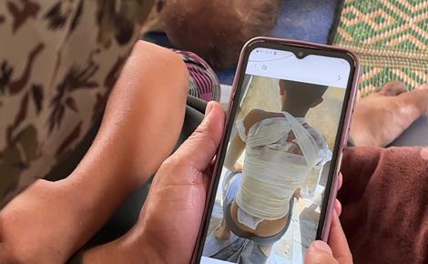 طعام التكية الساخن يحرق جسد جمال